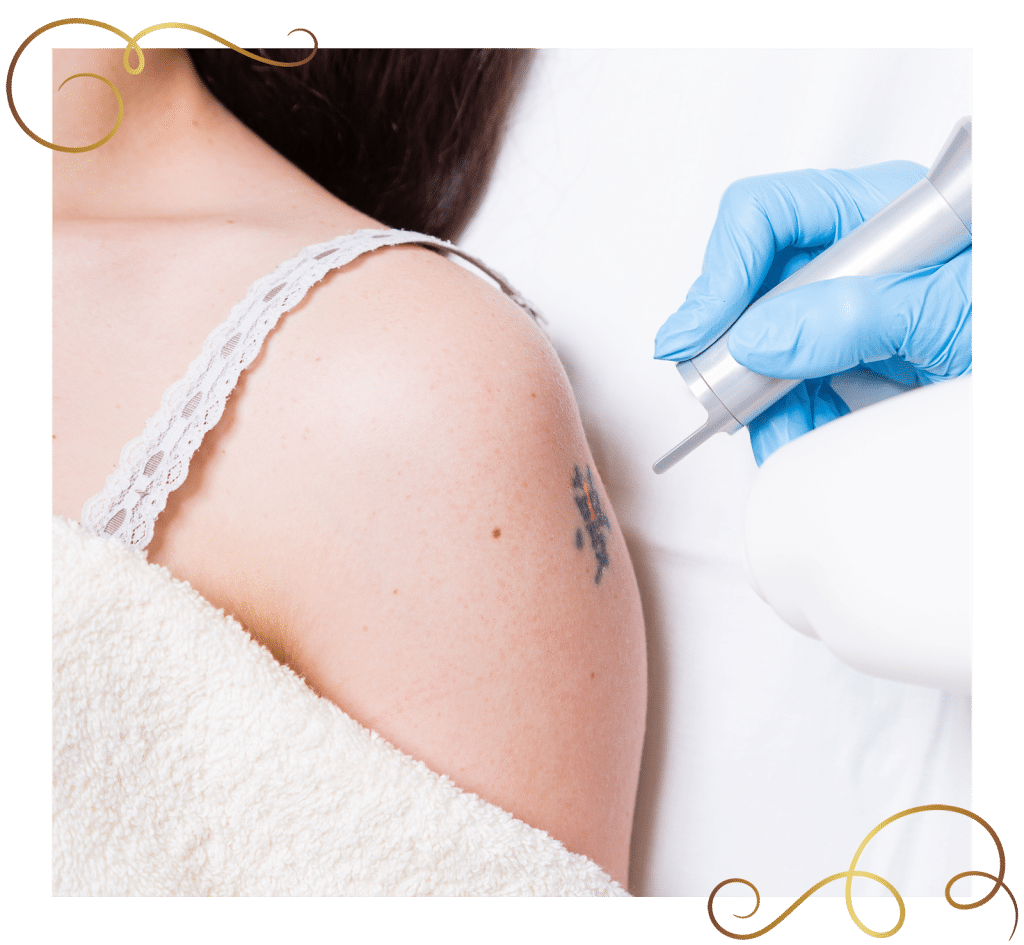 Laser Tattoo Removal - Azia Medical Spa